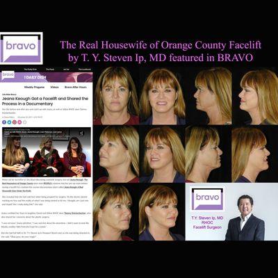 Bravo covers T. Y. Steven Ip, MD, Celebrity Beverly Hills Plastic Surgeon  - Facelift on Real Housewife of OC Star, Jeana Keough