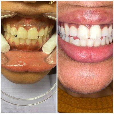 3 sessions of teeth whitening