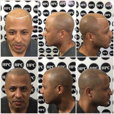 Hair line recreation using Scalp Micropigmentation for shaven males