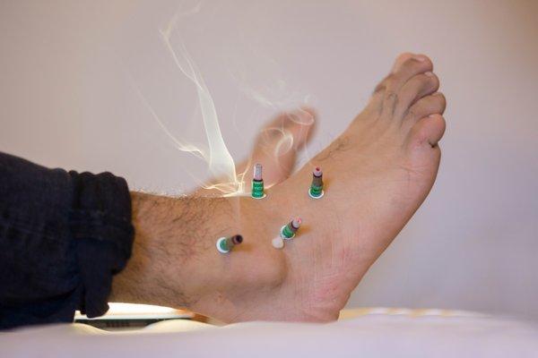 Moxibustion for a painful ankle