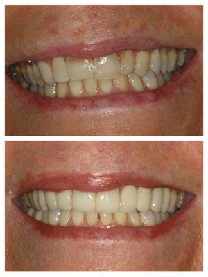 Bleaching and veneers