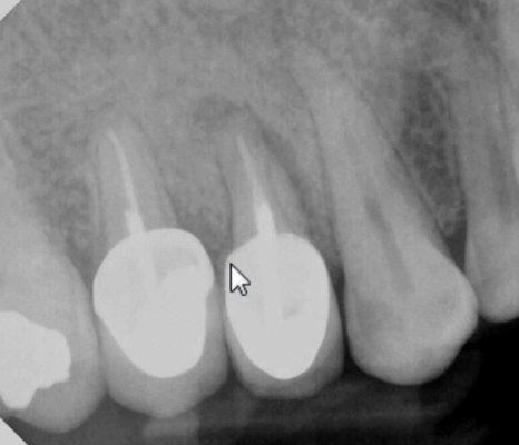 Fractured tooth with dark edges around roots