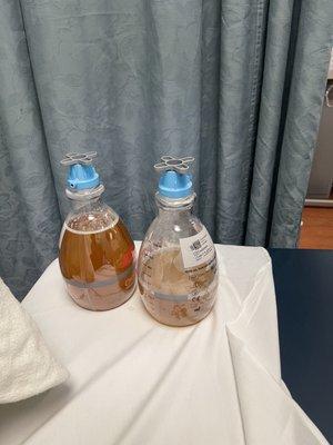 Two liter bottles of liquid removed in procedure involving lung.