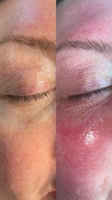 Plasma Fibroblast treatment under eyes