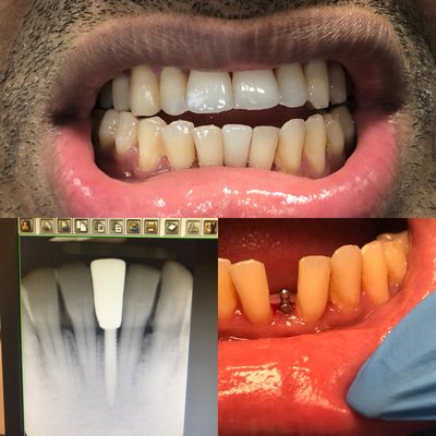 Gap closed with mini dental implant.