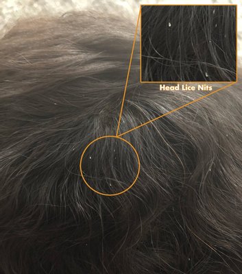 Nits attached to hair strands