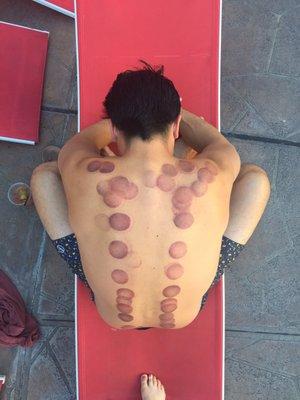 Cupping results- It was painless and everyone thought I was a pro swimmer or that I just got into a fight with an octopus.