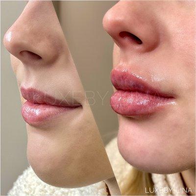 Hyaluronic Acid Lip Fillers, Needleless 1mL