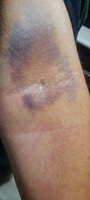 My arm 5 days after the injury