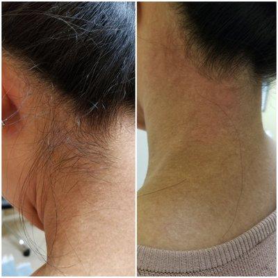 Before/ After left side of nape