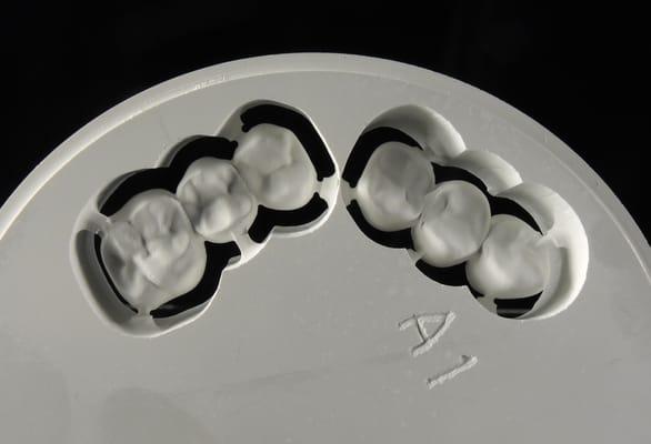 Precision milled zirconia crowns and bridges from Udell Dental Laboratory