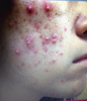 Fyi.  This is what my acne looked like before accutane.  Someone tell me I don't know what acne is.  (Side 1)