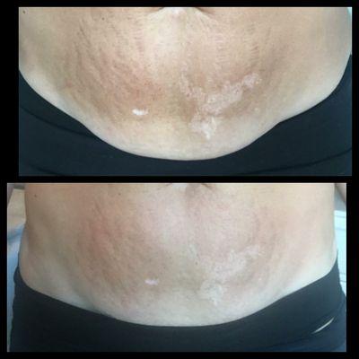 Lipo Cavitation/Skin Tightening results after 5 sessions