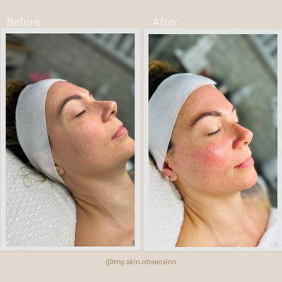 Platinum Hydrafacial before and after