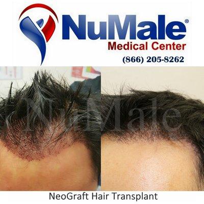 NeoGraft (FUE) Hair Transplant for Men. NuMale Medical Center