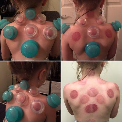 Cupping Kids