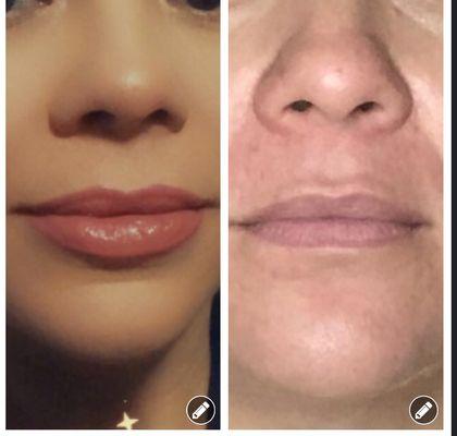 Lips filler