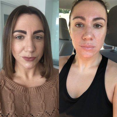 On the left is right before I had any Botox and the right is after 6 months and getting Botox twice.