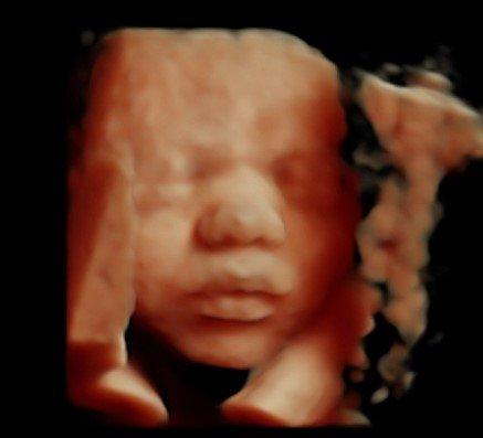 hd 3d4d ultrasound