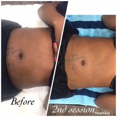 Fat cavitation slimming and tightening