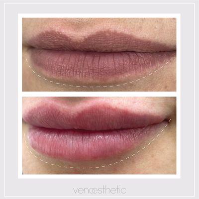 Lip augmentation and definition