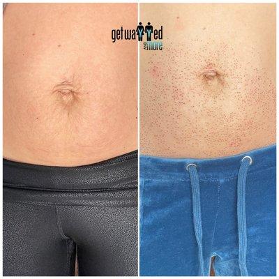 Fibroblast skin Tightening full stomach