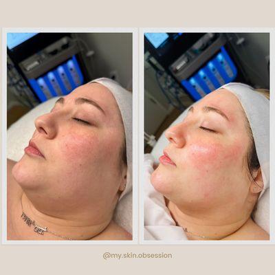 Platinum Hydrafacial before and after