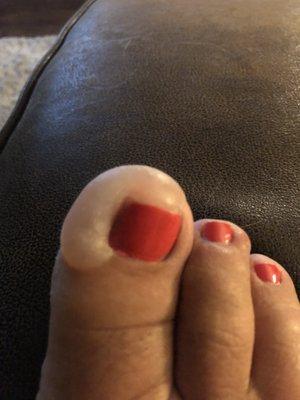 Update to my review dated 7/27/21 - this is 8 days after my pedicure. The bubble is still growing and it's painful to walk.