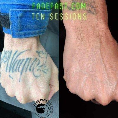 Fade Fast Tattoo Removal