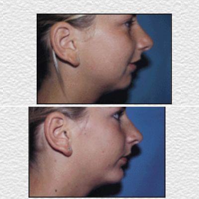 B&A Chin Augmentation