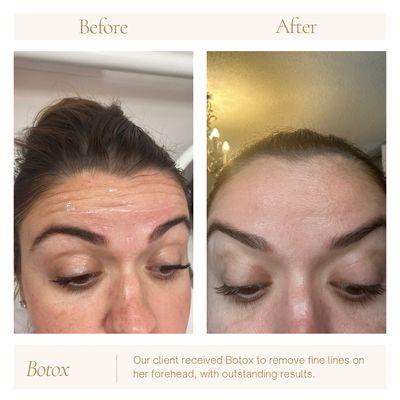 Botox Before and After, with incredible results reducing fine lines on our client's forehead