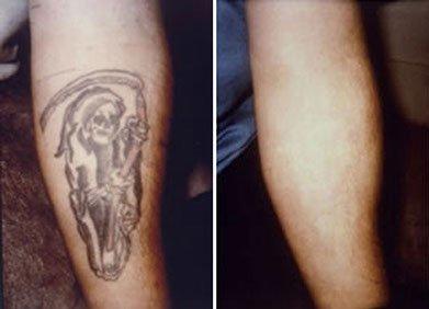 Tattoo Removal Bridgewater, Pa