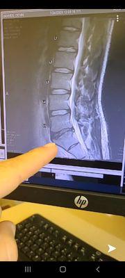 Recent M.R.I of my lower back.