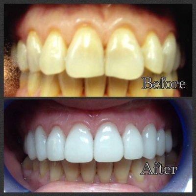 Cosmetic Case ( Veneers)