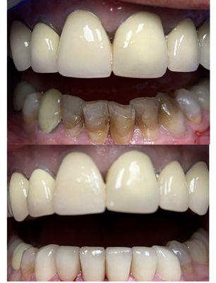 Here is before & after of the bottom teeth. (Top teeth done by prior dentist)