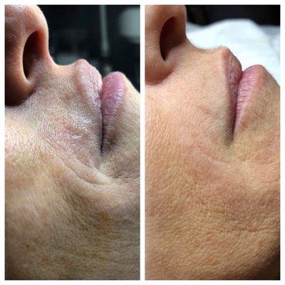 Before & After Plasma Fibroblast Therapy. Used to help tighten and smooth the appearance of the skin.