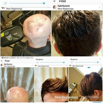 Alopecia Universalis