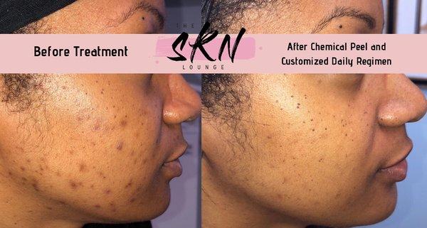 Acne and discoloration before & after our Rejuvenating Chemical Peel