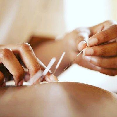 Acupuncture needles are gentle hair thin needles! They are painless!