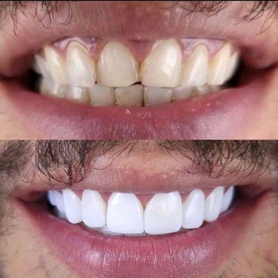 Zirconium Porcelain Veneers (Before and After)