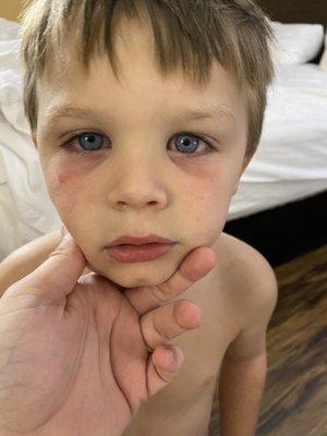 My sons face after being in the pool. That isn't sunburn and he could barley keep his eyes open.