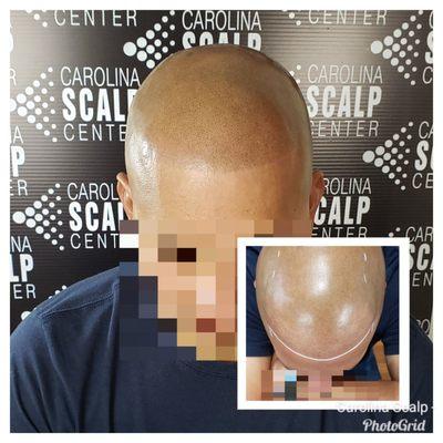 Scalp Micropigmentation is great for repairing botched hair transplant surgeries.