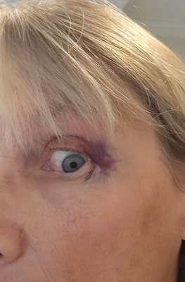 Bruising From Botox Injection