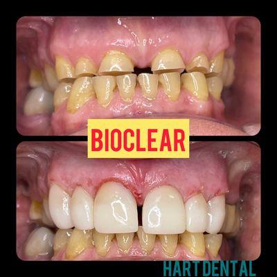 No drilling of your natural tooth structure! This is conservative cosmetic dentistry at its finest. Dr Iwona's latest Bioclear case !