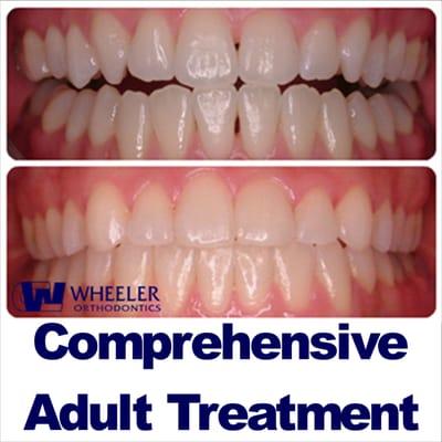 Actual comprehensive treatment at Wheeler Orthodontics.