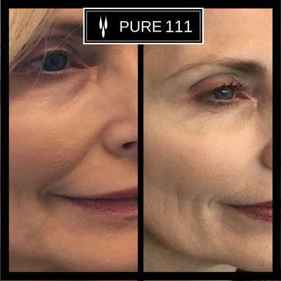 Sculptra before and after, adding volume to cheeks and marionette lines.