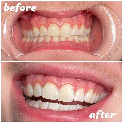 30 minute whitening session