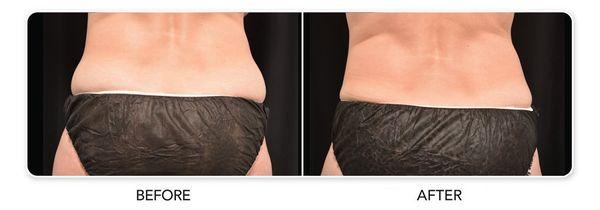 Before and after CoolSculpting® results on female love handles