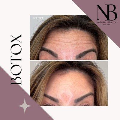 Get rid of those forehead lines with Botox! Quick and easy, Botox erases those forehead lines quickly!