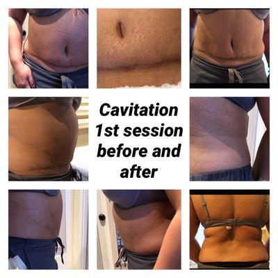 Body Cavitation  first session before and after.